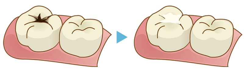 小さな虫歯