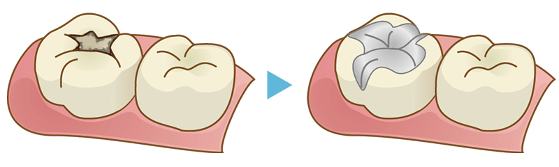 レジンの周りが虫歯になる