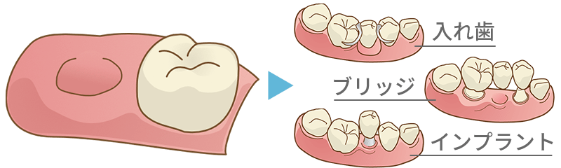 抜歯