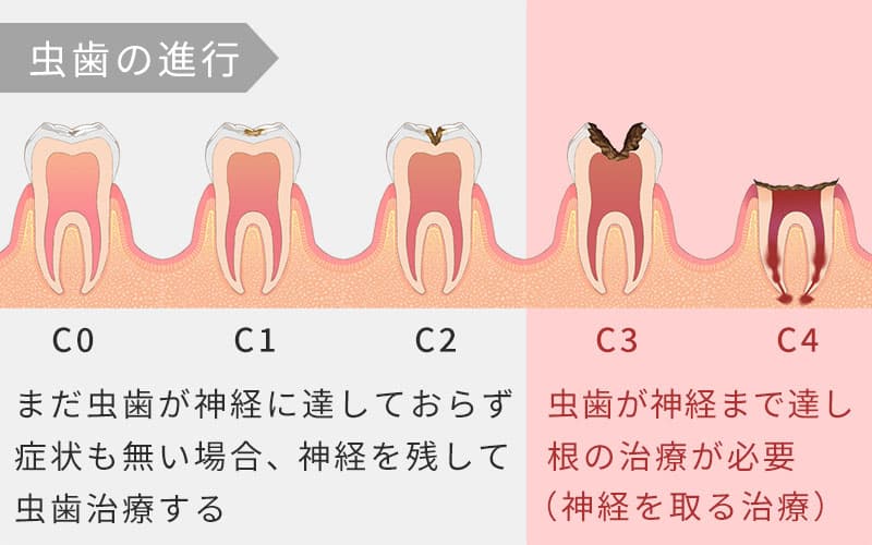 神経を取る治療