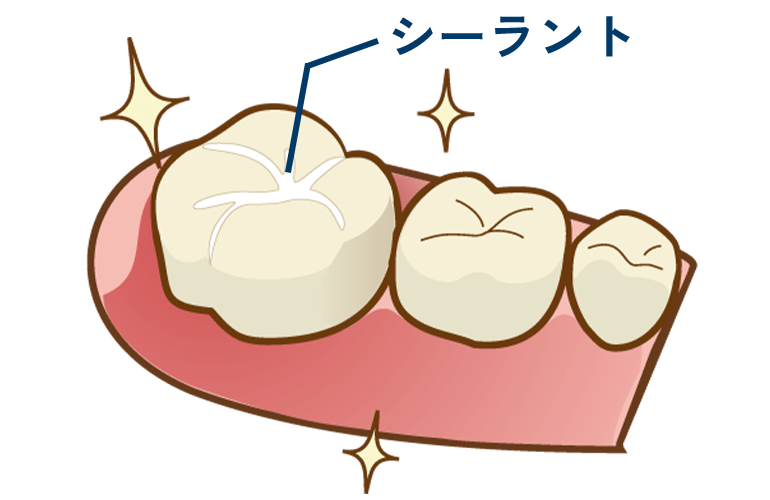 シーラント