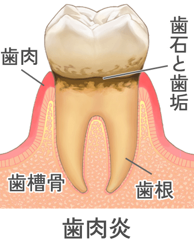 歯肉炎