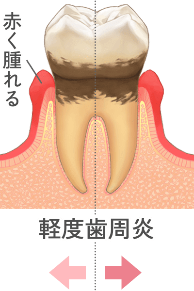軽度歯周炎
