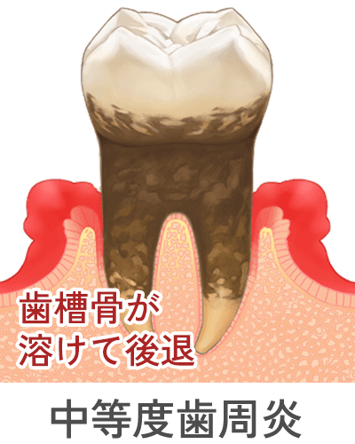 中程度歯周炎