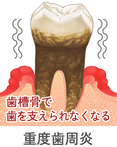 重度歯周炎