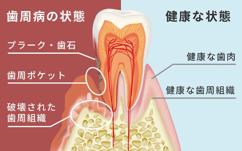 歯周病